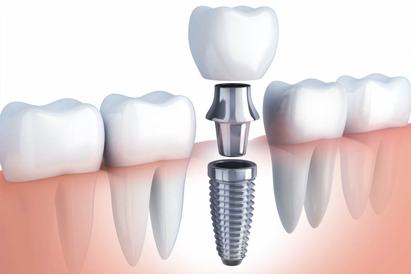 Dental Implants in Folsom