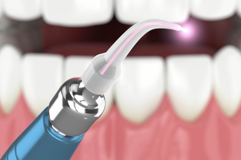 Laser Dentistry in Folsom