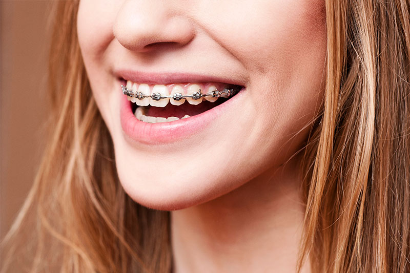 Orthodontics in Folsom